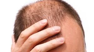 Top Home Remedies To Get Rid Of Baldness